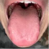 又是一个典型的阴虚火旺的舌头，切忌大补肾阳，会给夫妻生活火上浇油！
 
患者情况