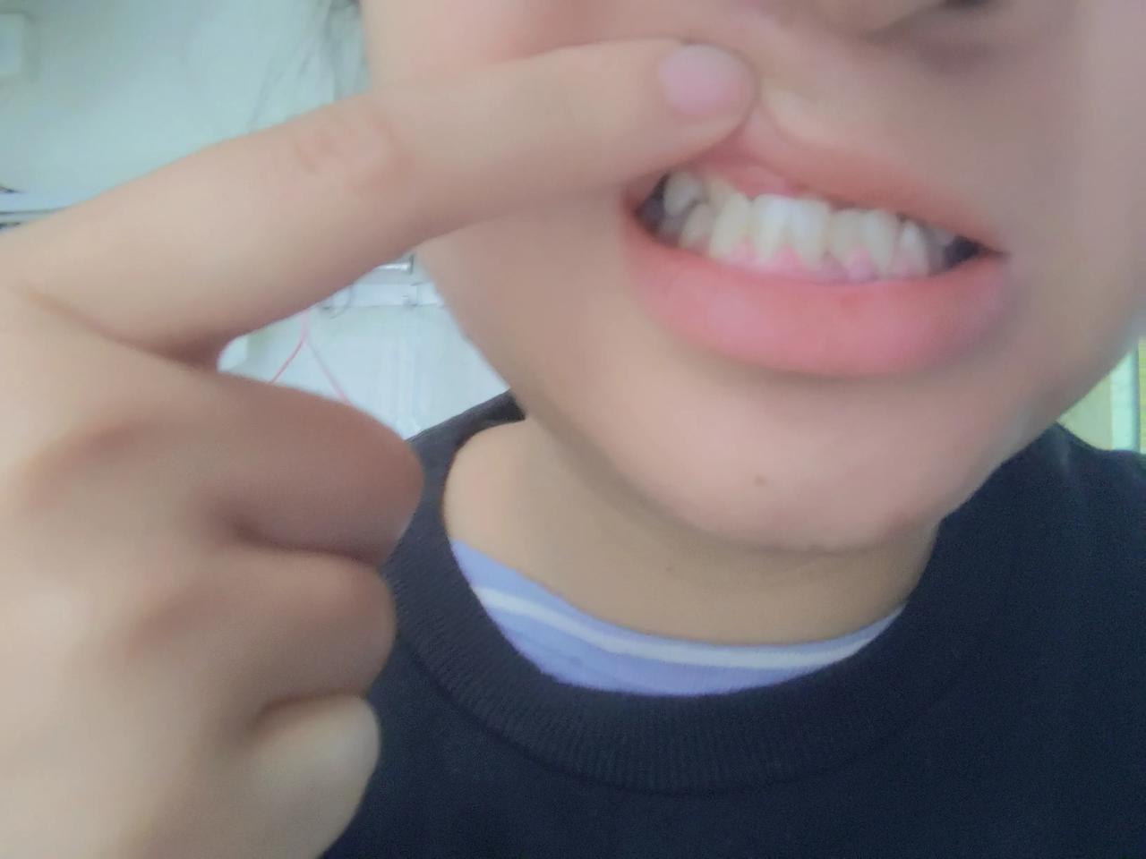 #万能生活指南#活了快三十年，才发现原来我的牙齿是地包天，我的瘪嘴不是天生的！
