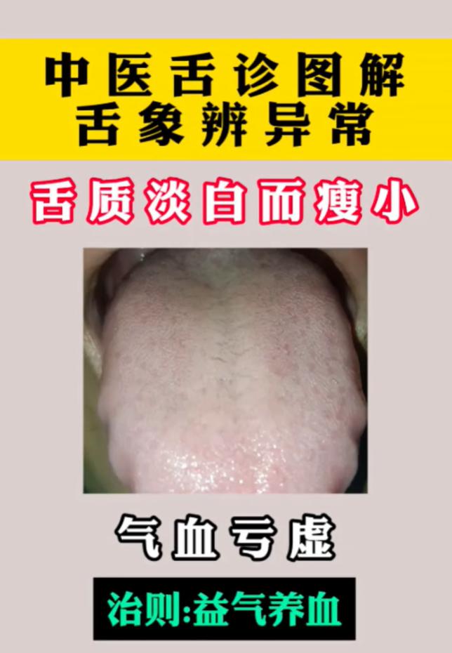 舌诊小科普：不同舌头代表什么状态