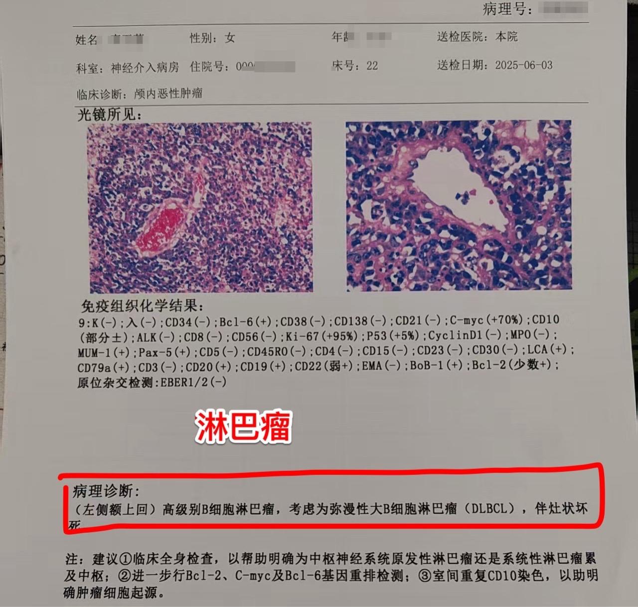 脑部原发的淋巴瘤和血液科的淋巴瘤不一样。63岁的因头痛、右腿活动无力经...