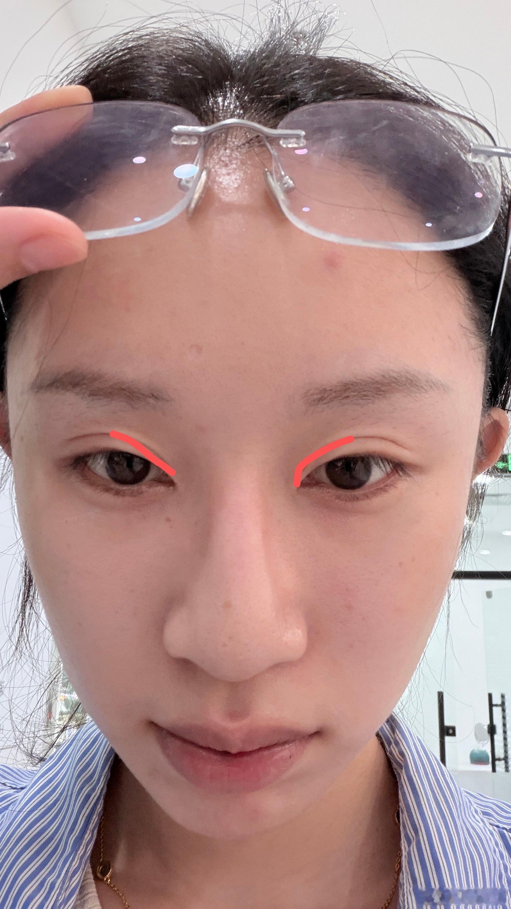 面诊结束 大概就是眼头会降窄一点  明天就do了 