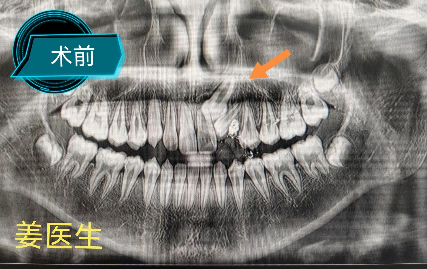 埋伏阻生尖牙。正畸转诊，拔除埋伏阻生尖牙。