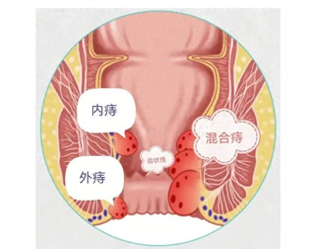 便血、瘙痒、脱出！一到秋天痔疮就找上门，怎么办？