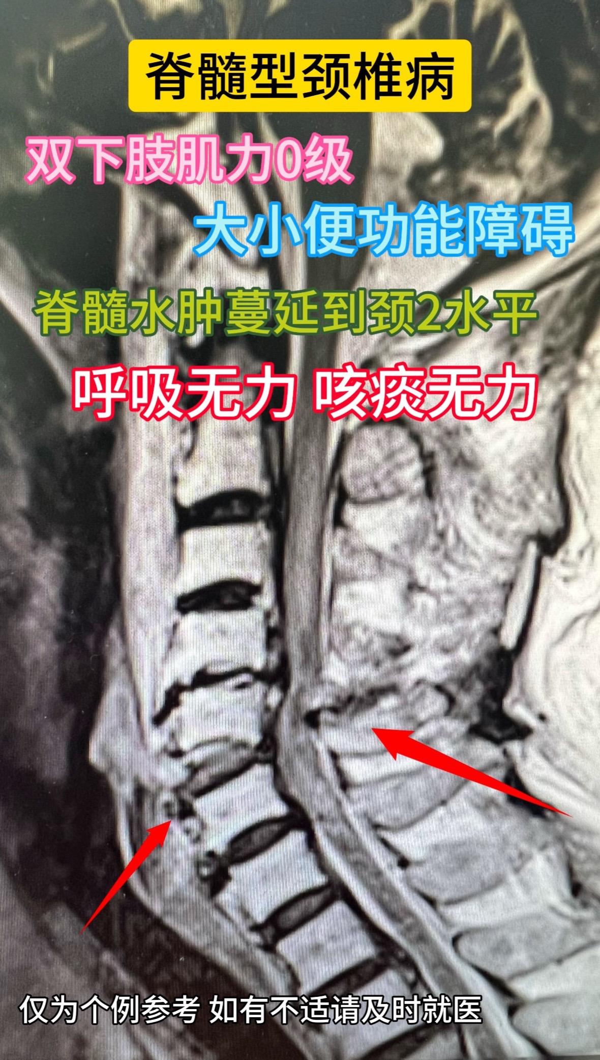 70岁男性患者，脊髓型颈椎病。患者双下肢无力3年余。2天前无力加重，摔...