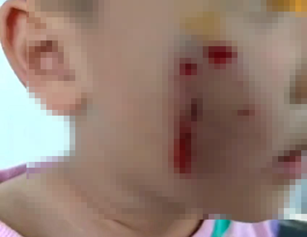 #男童被流浪狗咬伤右脸缝了20针#【5岁男童被流浪狗咬伤 母亲：孩子右脸缝了20