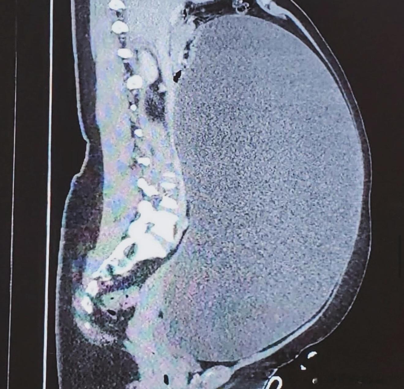 44 pound (20 kg) ovarian cyst! 😳 imagin