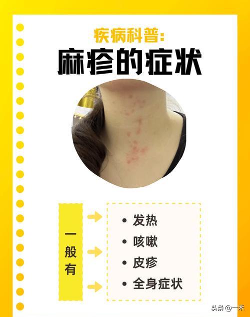 全球麻疹疫情反弹，中疾控发声：孩子疫苗千万别漏！
 
家人们注意了！近期全球麻疹