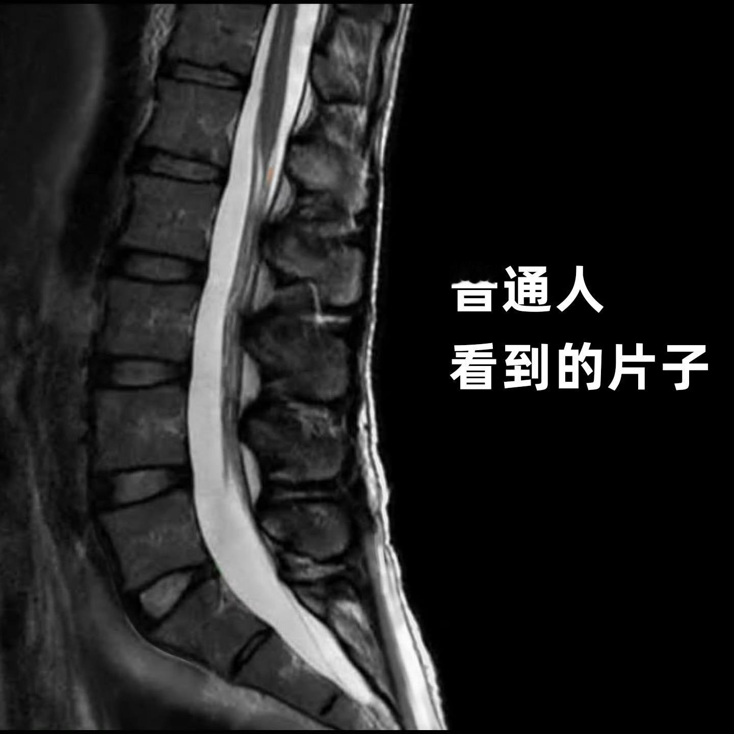 腰椎间盘突出 经典对比图，来带你认识“真实”的腰椎拍过核磁片子的朋友，有没有看到