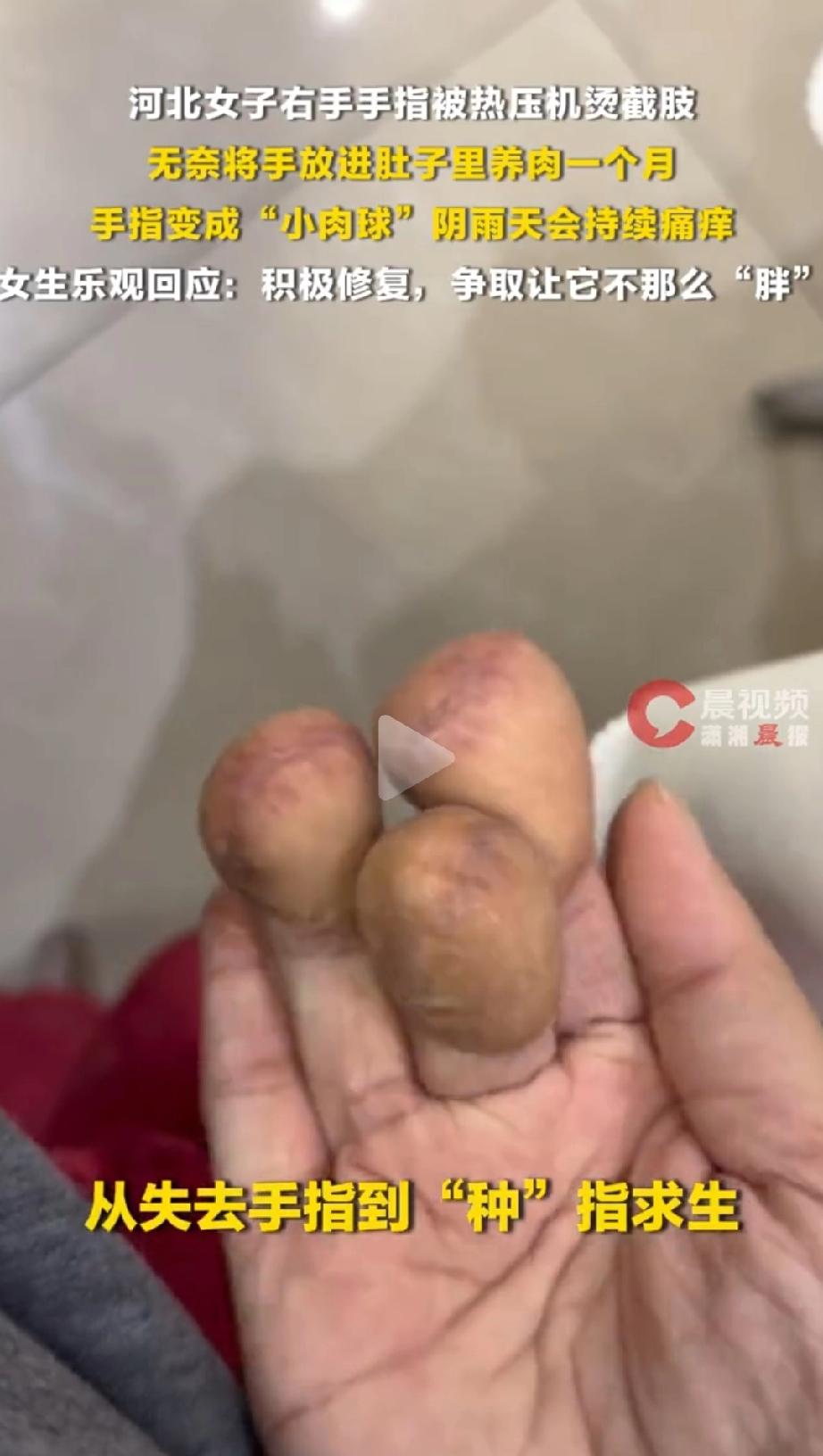 太神奇了！河北沧州，一位女子去年夏天工作时右手被机器严重烫伤，不得不截肢。万万没