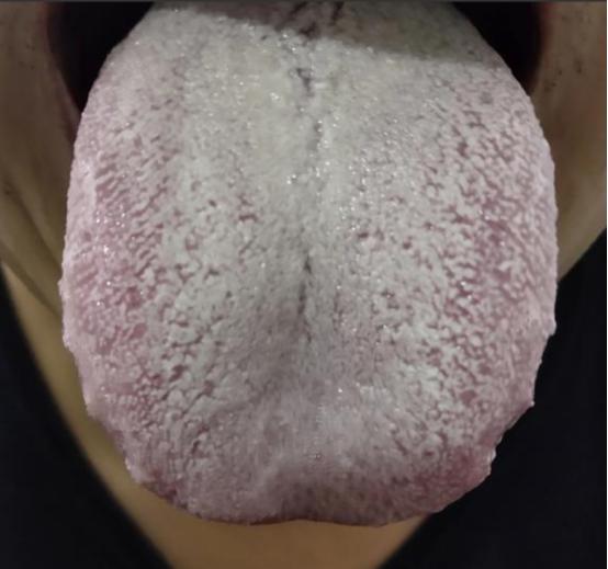 这种舌头，吃再多的参苓白术，都是白费工夫，明显是真武汤舌象！
 
主诉：夫妻生活