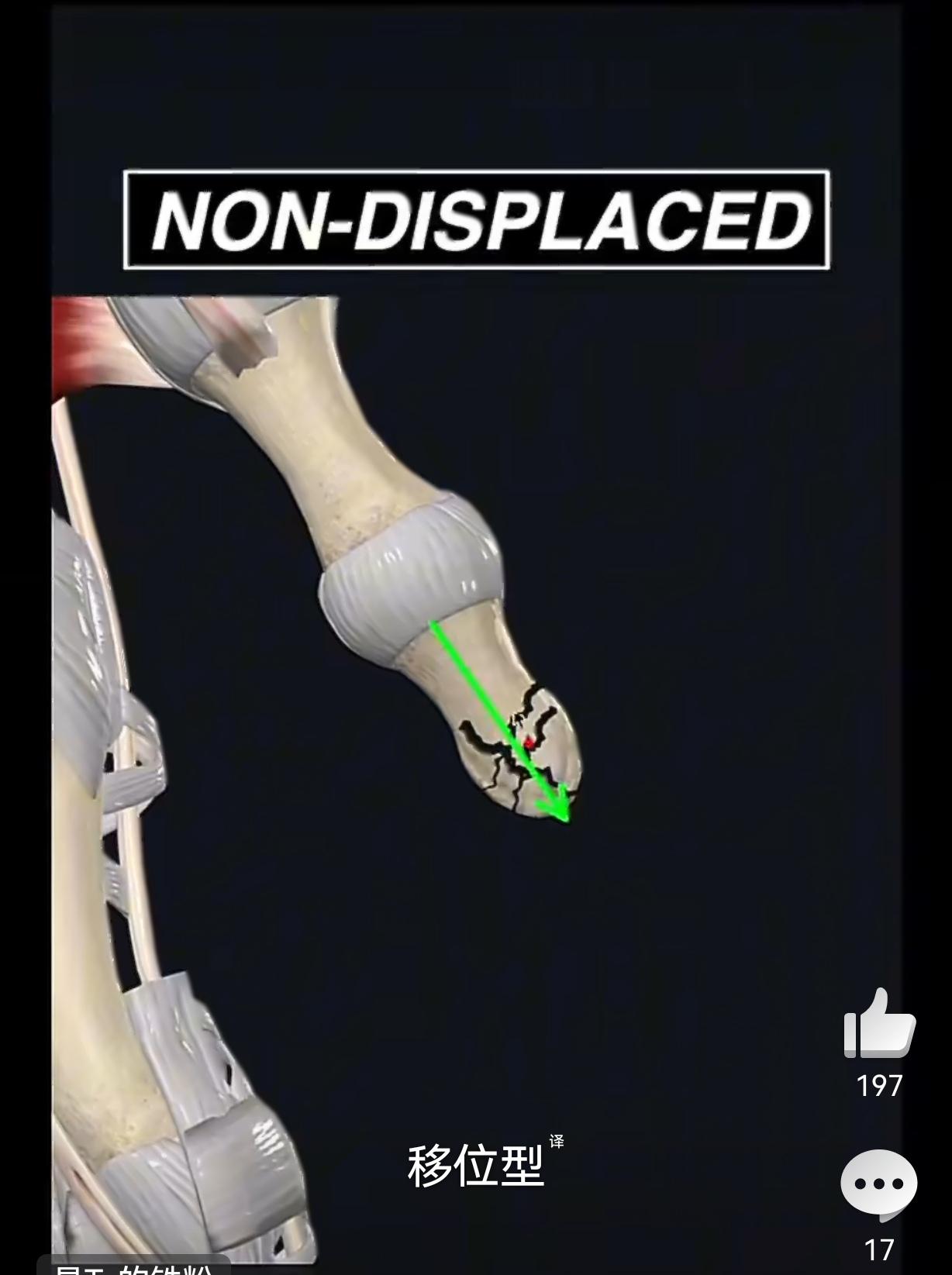 哈登的拇指骨折的示意图是下面这样的！不用手术，但是一定会疼，一定会影响哈登的动作