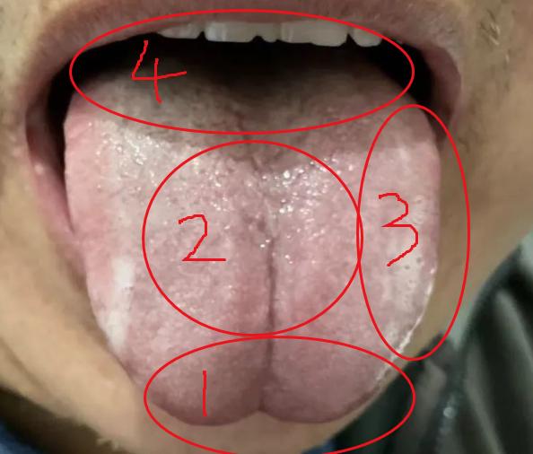 这种舌象是典型的少阳阳明合病！
 
患者咨询，舌像分析
患者自述：胸闷，大便干，