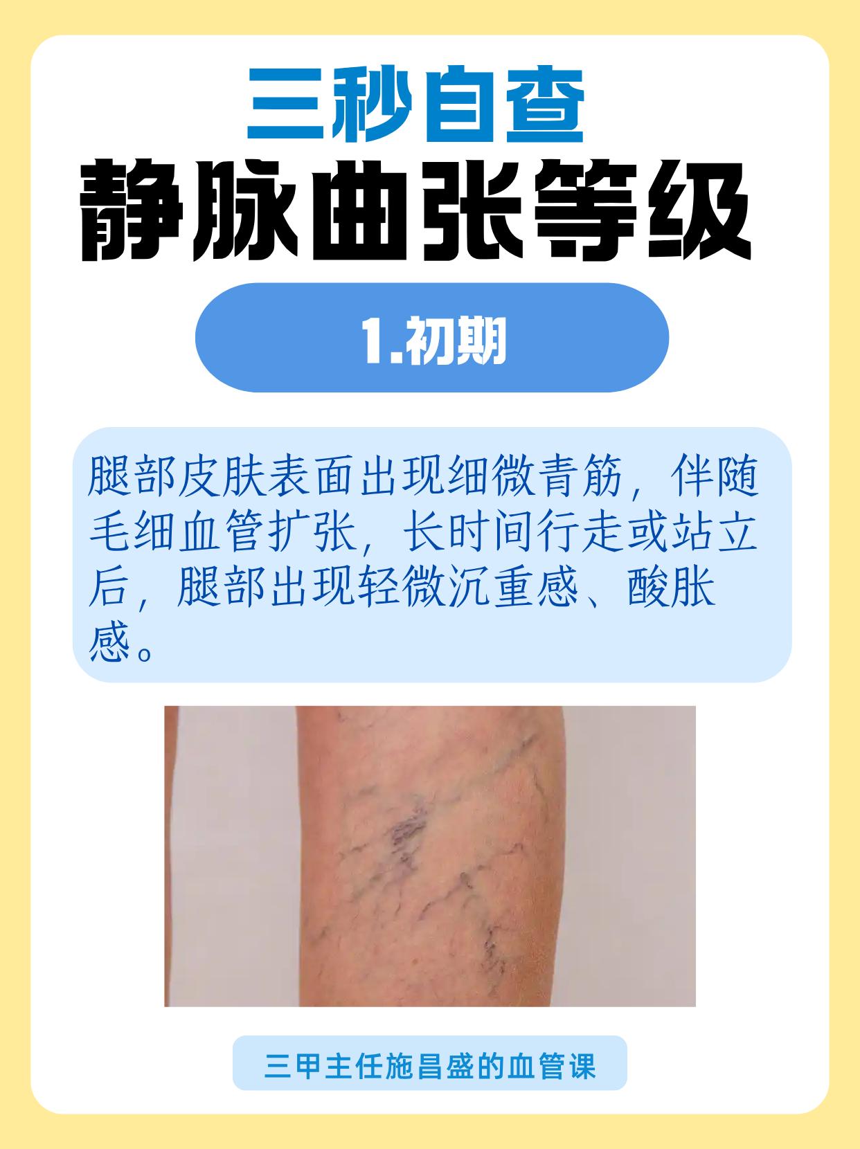 三秒自查静脉曲张等级。多个典型症状帮助判断，快速自查静脉曲张所处阶段。