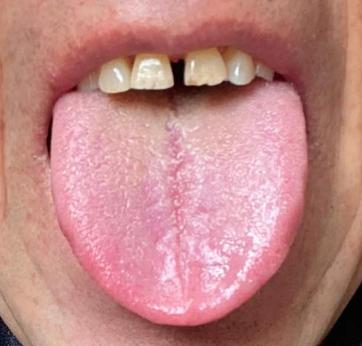 舌中裂纹 + 红舌，还又怕冷又口干？这是寒热错杂，肝脾肾都在 “喊累”！
大家好