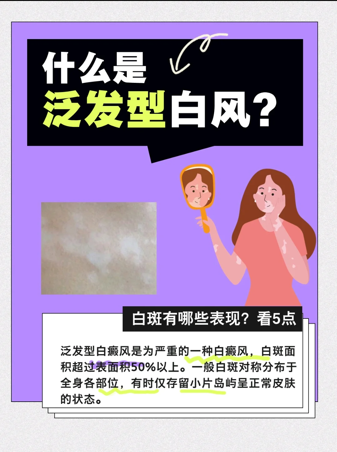 ↖️什么是泛发型白癜风？白斑有哪些表现？