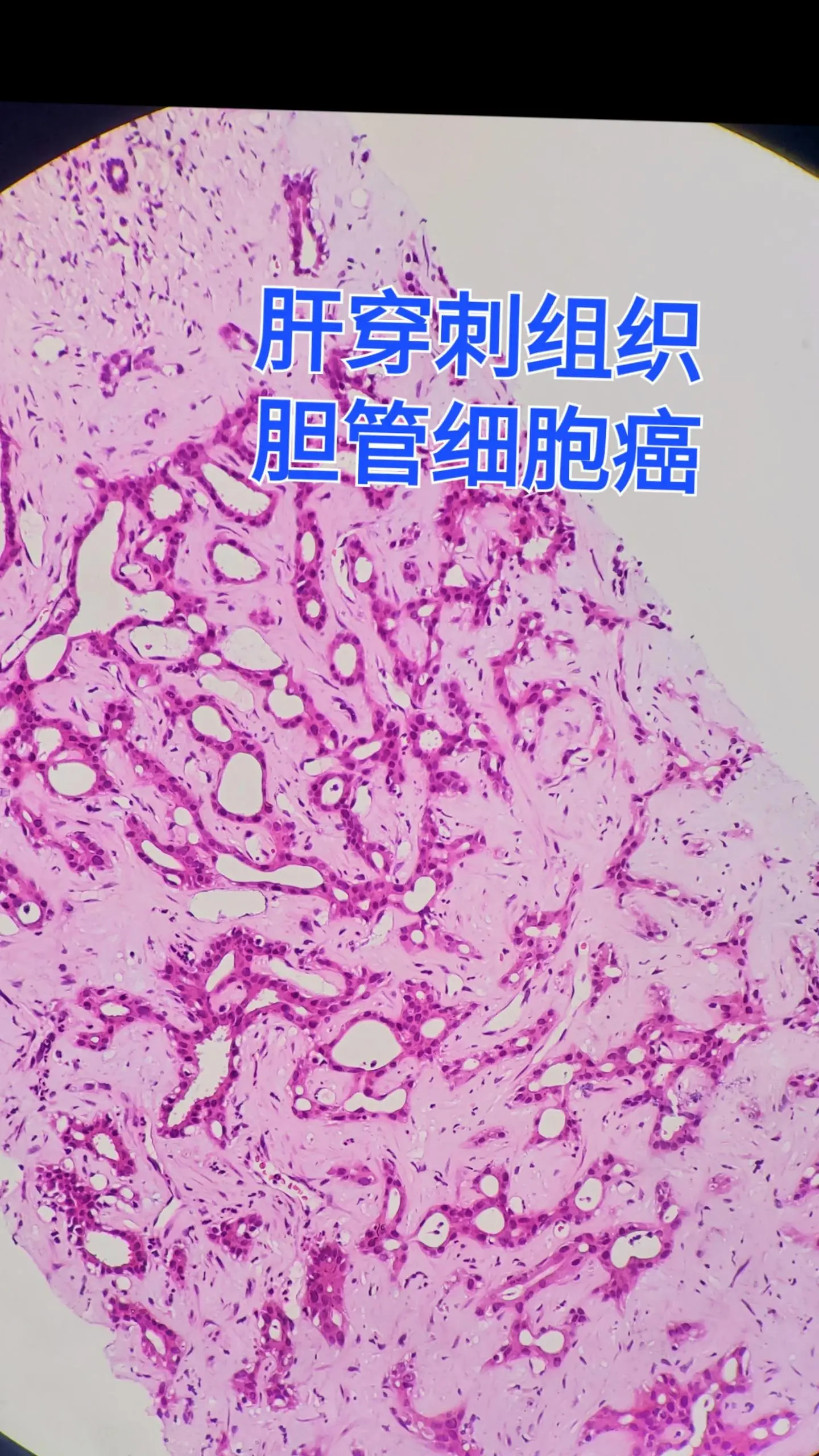 肝胆管细胞癌
