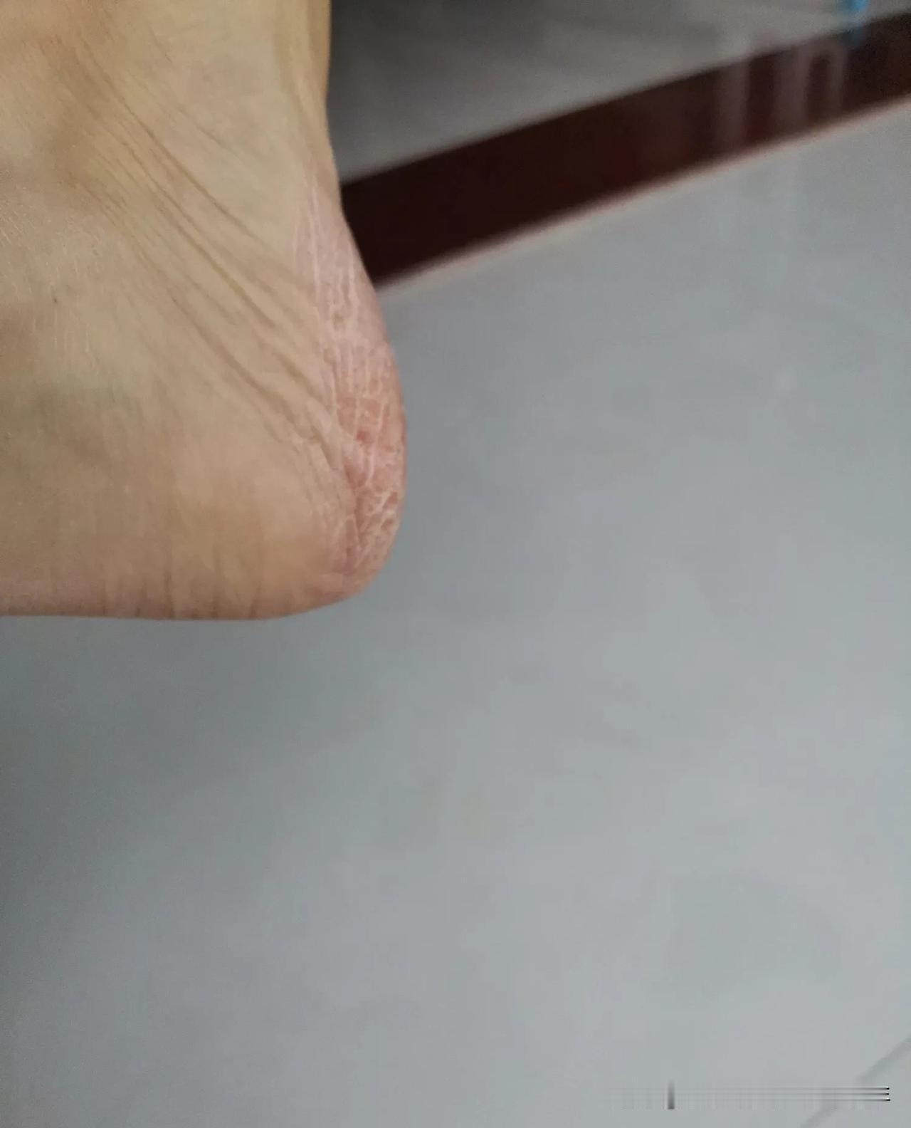 我有个难题，脚后跟无论春夏秋冬总是裂开，冬季尤其糟糕，有时还会流血，走几步路都疼