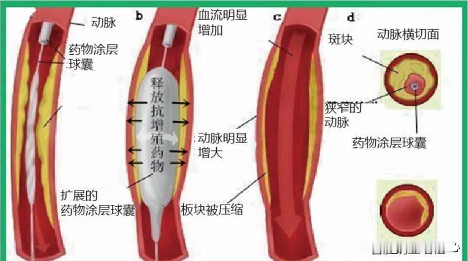 药物球囊和支架有什么区别？前几天一个朋友私信问我这个问题@悠闲小青蛙 ，一直没有