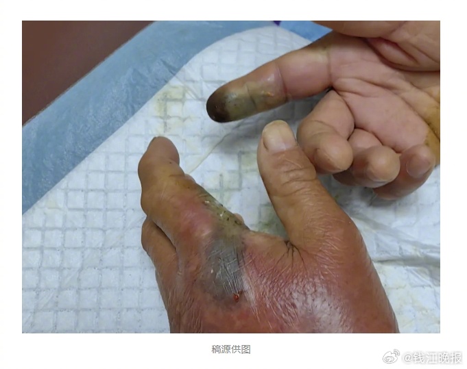 【 #男子被毒蛇咬伤忍痛去抓又来一口# 】热爱垂钓的王大伯经常去水库甩两杆。一天