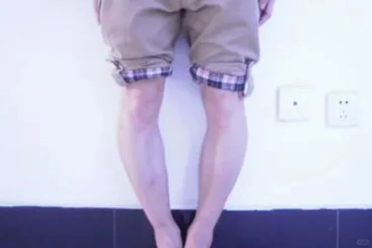 O型腿是什么样子