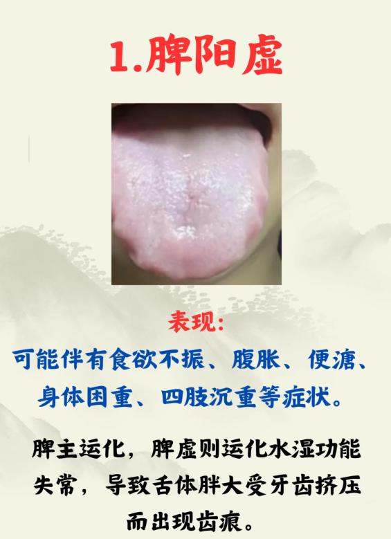 齿痕舌别只怪湿气重，5 种证型对照看