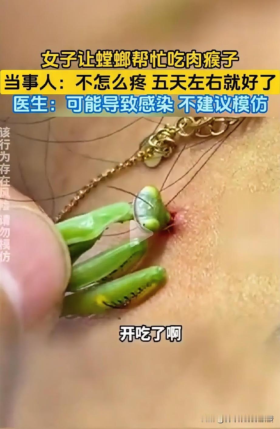 女子身上长了个肉瘊子，

有意思的是，

她竟然找了个

螳螂来帮忙吃掉。
——