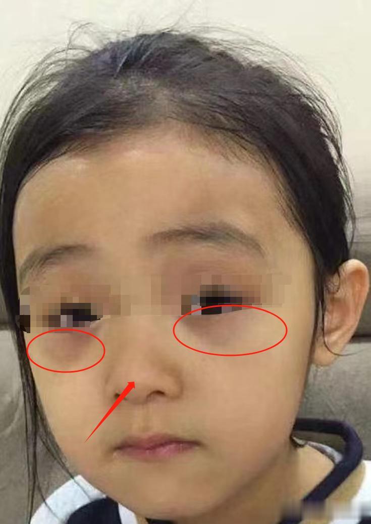 鼻子也是反映孩子脾胃情况的“镜子”！

脾胃的位置在鼻部，鼻准头为脾，鼻翼部分为
