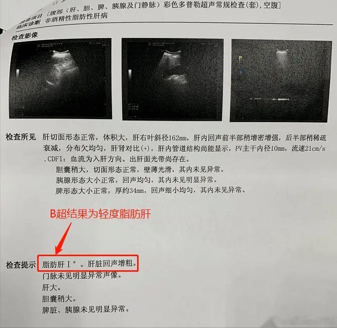 这5项指标异常，一般不需要用药1. 轻度脂肪肝，绝大多数患者都不用吃药，只要注意