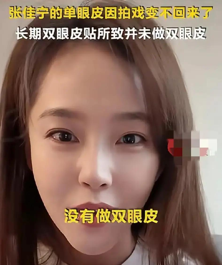 张佳宁直播里说自己没动刀，双眼皮是贴出来的。
她左眼天生双，右眼单，天天贴胶带，