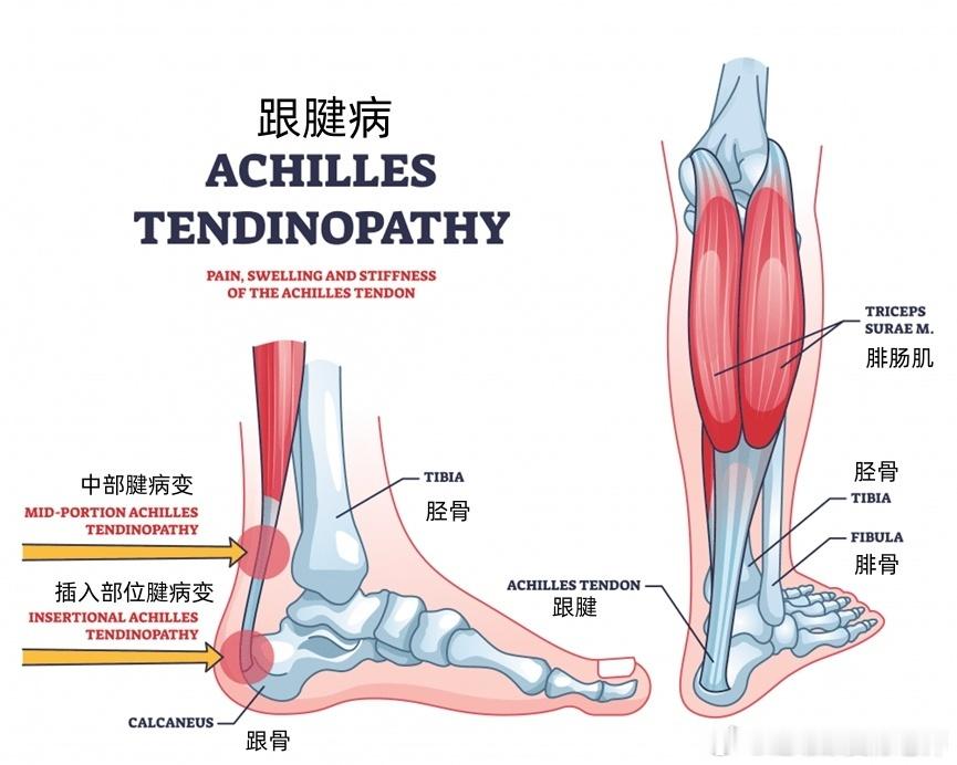 跟腱病  讲过了跟腱撕裂，今天再讲一个跟腱损伤——跟腱病变，它不像跟腱撕裂那么严