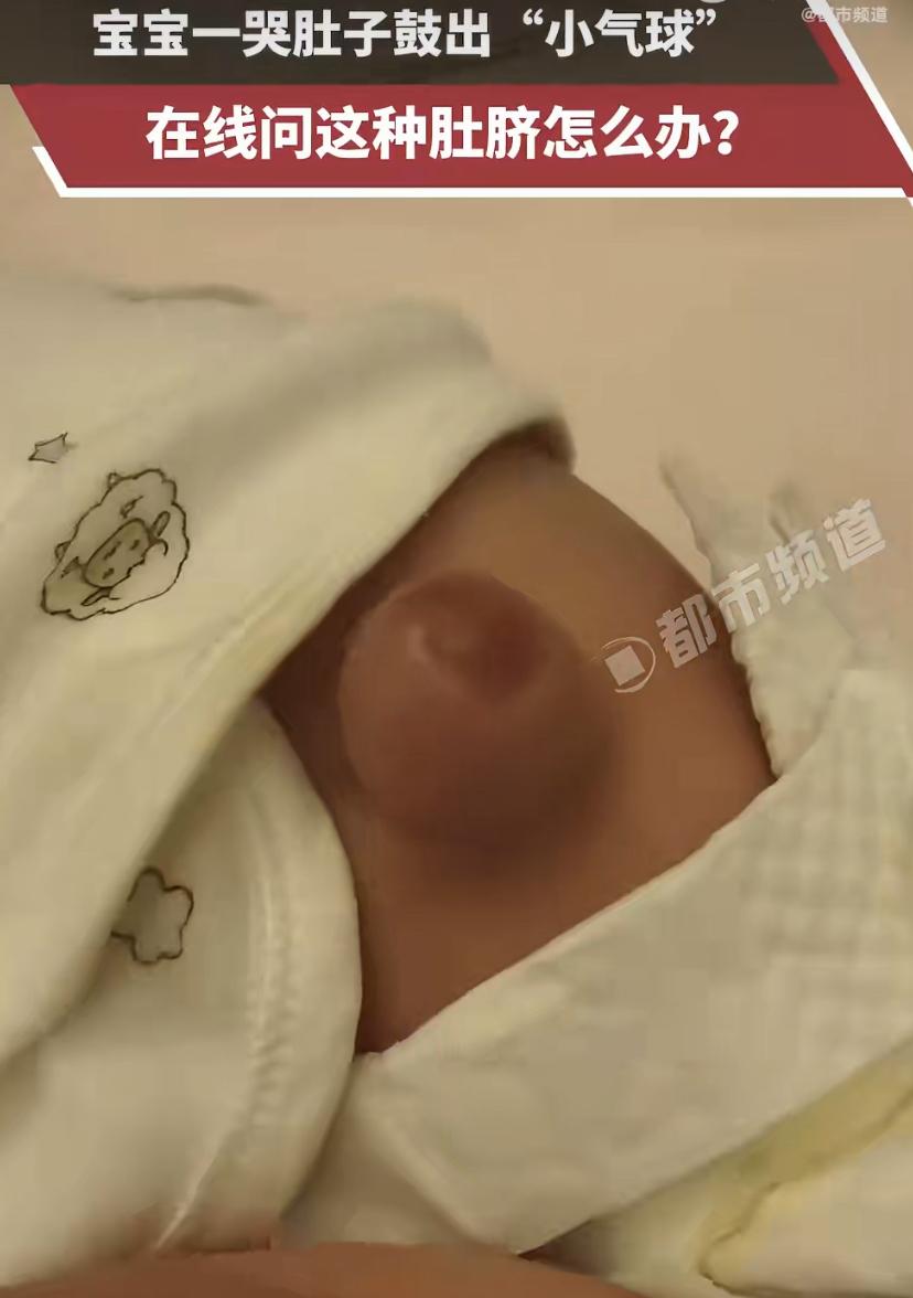 宝宝一哭，肚脐眼秒变"小气球"
四川有位宝妈近期发现，自家娃只要一使劲哭，肚脐眼