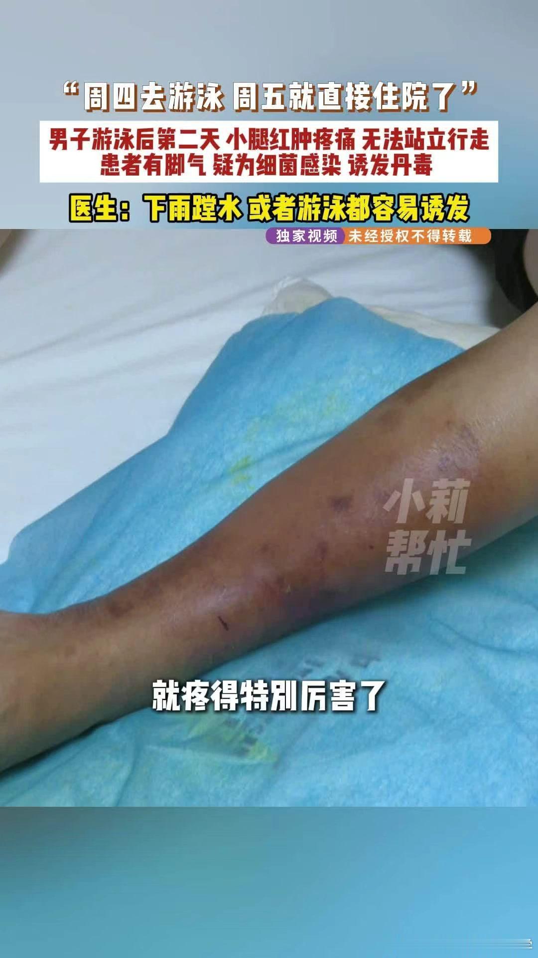 男子患脚气游泳后第2天无法行走男子患脚气去游泳后诱发丹毒无法走路丹毒这病真不是开