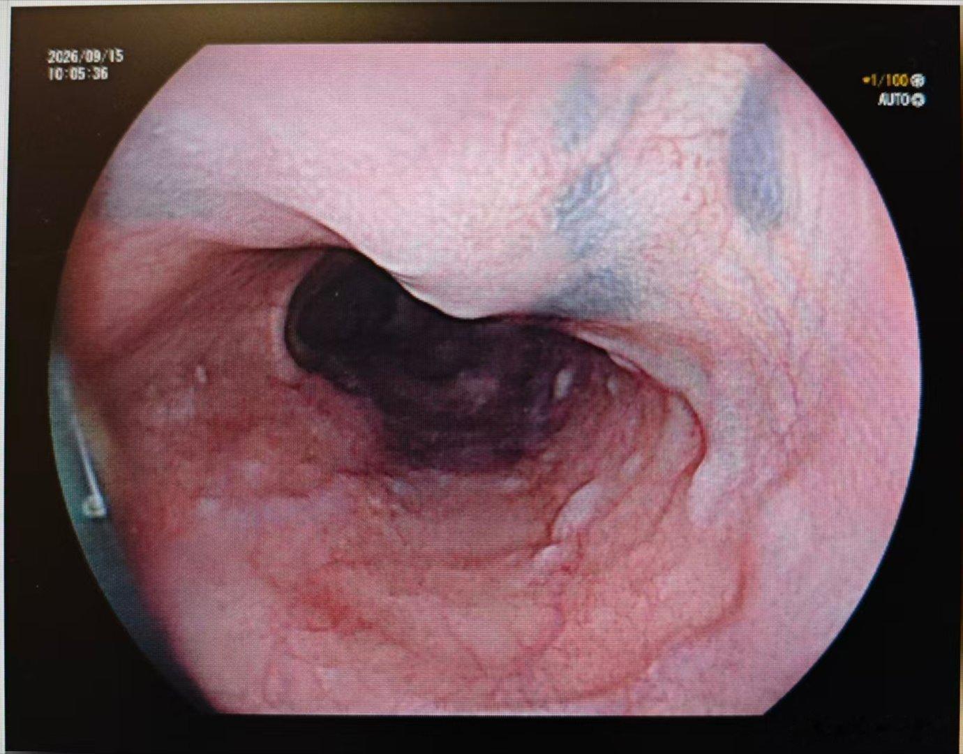 食管黑色素沉着（食管黑变病/食管黑素细胞增多症，Esophageal melan