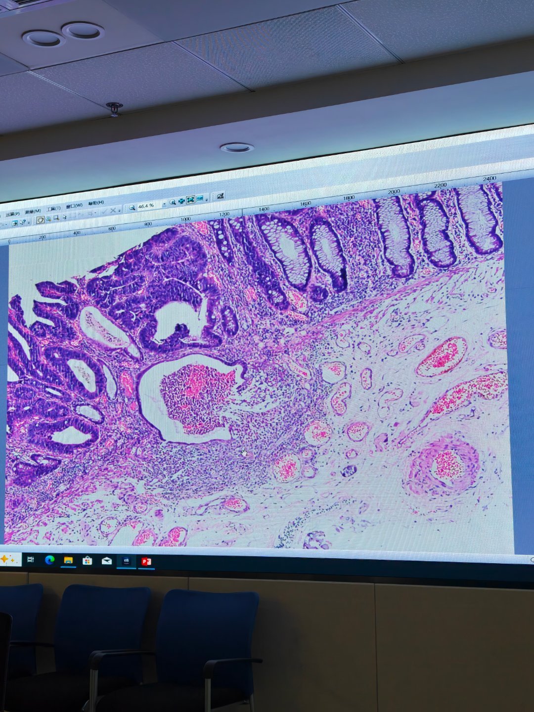 PAP = Papillary adenocarcinoma，乳头状腺癌（日本消