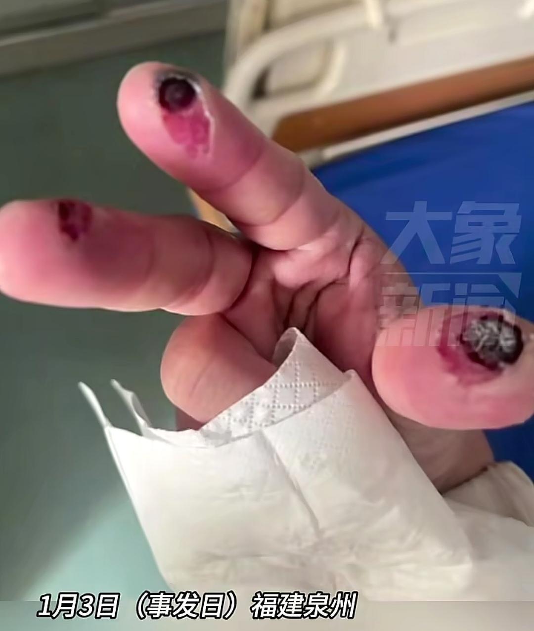 浙江一女子因踩到氢氟酸，不到24小时就医治无效。我去网上查了下，一查不知道，查了