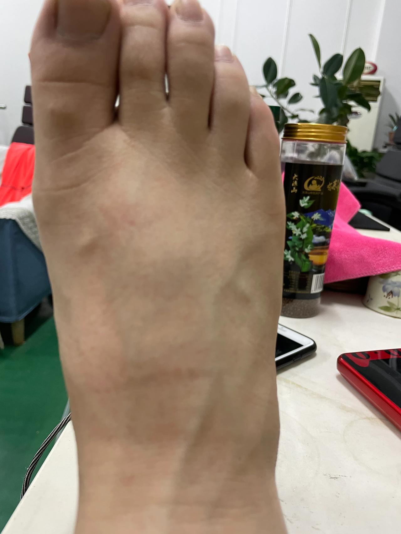 体育锻炼 没做好热身和准备活动的后果 这是24小时内的肿胀变化 这次没崴到脚踝 