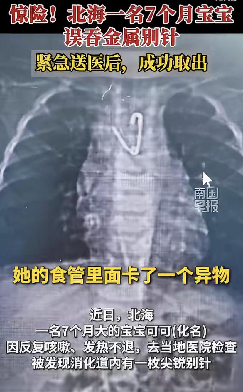 太吓人了!广西南宁7个月大的宝宝可可，又咳又发烧老不好。去医院一查，发现肚子里竟