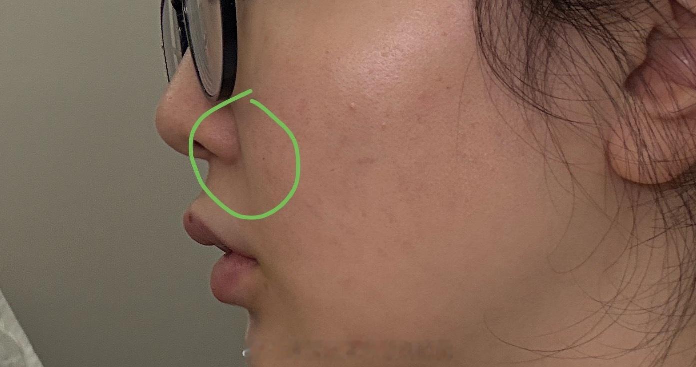 我拍了张自己的侧脸，我的天我鼻基底凹陷的不是很明显，所以我法令纹不是很重，如果你