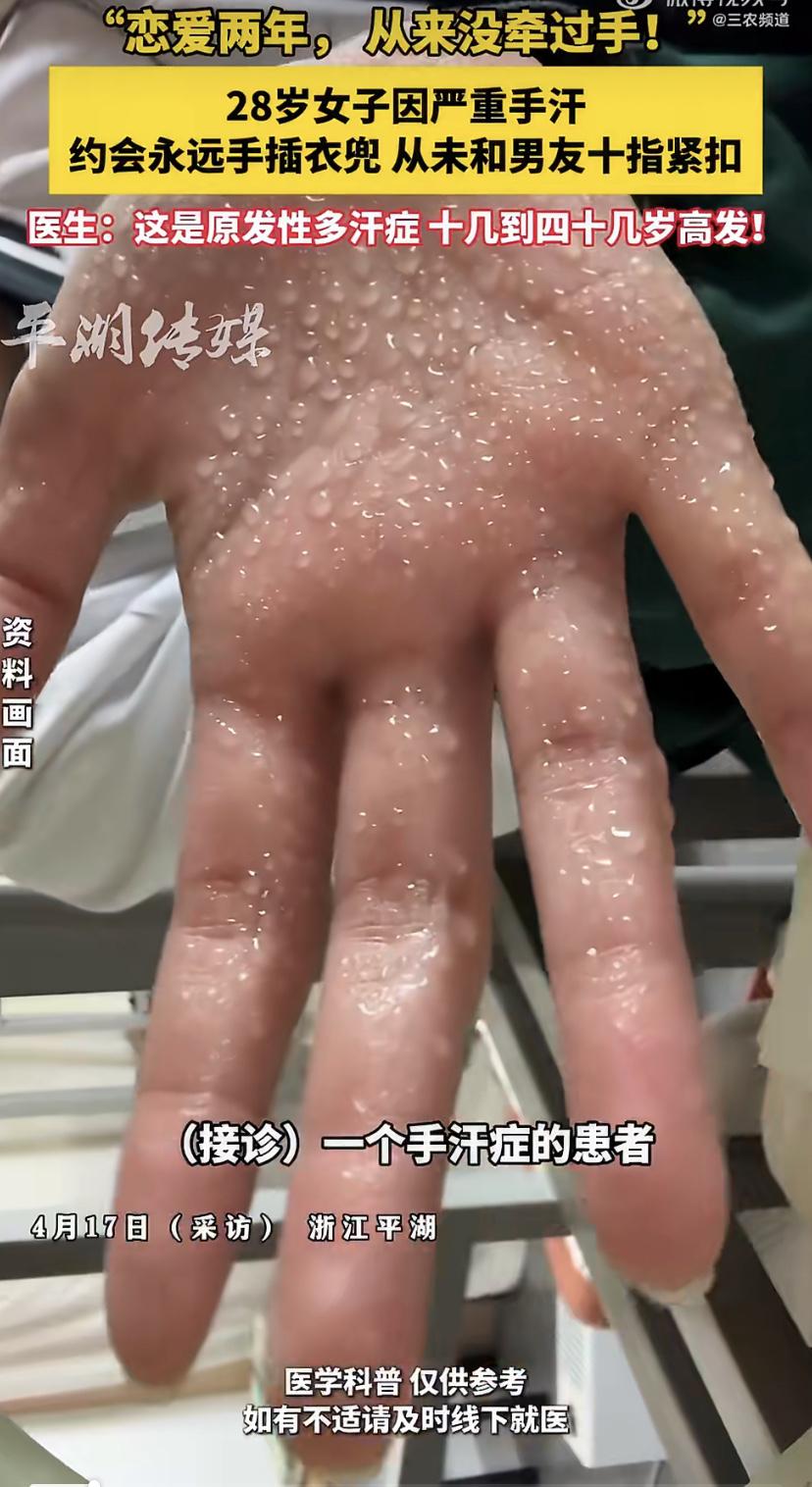 浙江28岁的小雅，因为手汗太严重，和男友恋爱两年，手都没牵过。约会时她的手永远藏