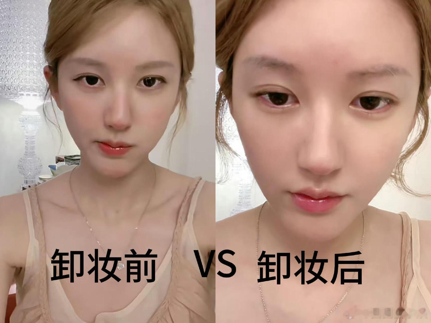 赵露思现场直播卸妆赵露思昨天直播卸妆，区别就是多了一些红血丝，皮肤太薄了。赵露思