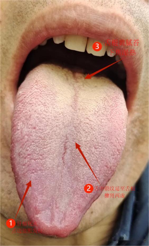 中医解析舌象三大问题：肝郁化火，脾肾两虚，下焦湿热[给力][给力][给力]
观察