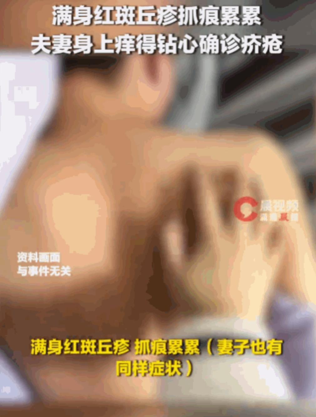 福建，一名男子在朋友家借宿几天后，腹部和大腿就痒得钻心。他自以为是湿疹，竟天天用