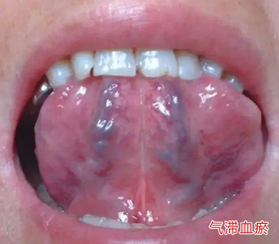 同样是血瘀重，但是你知道自己是属于哪种情况吗？又该如何调理？

1、气滞血瘀——