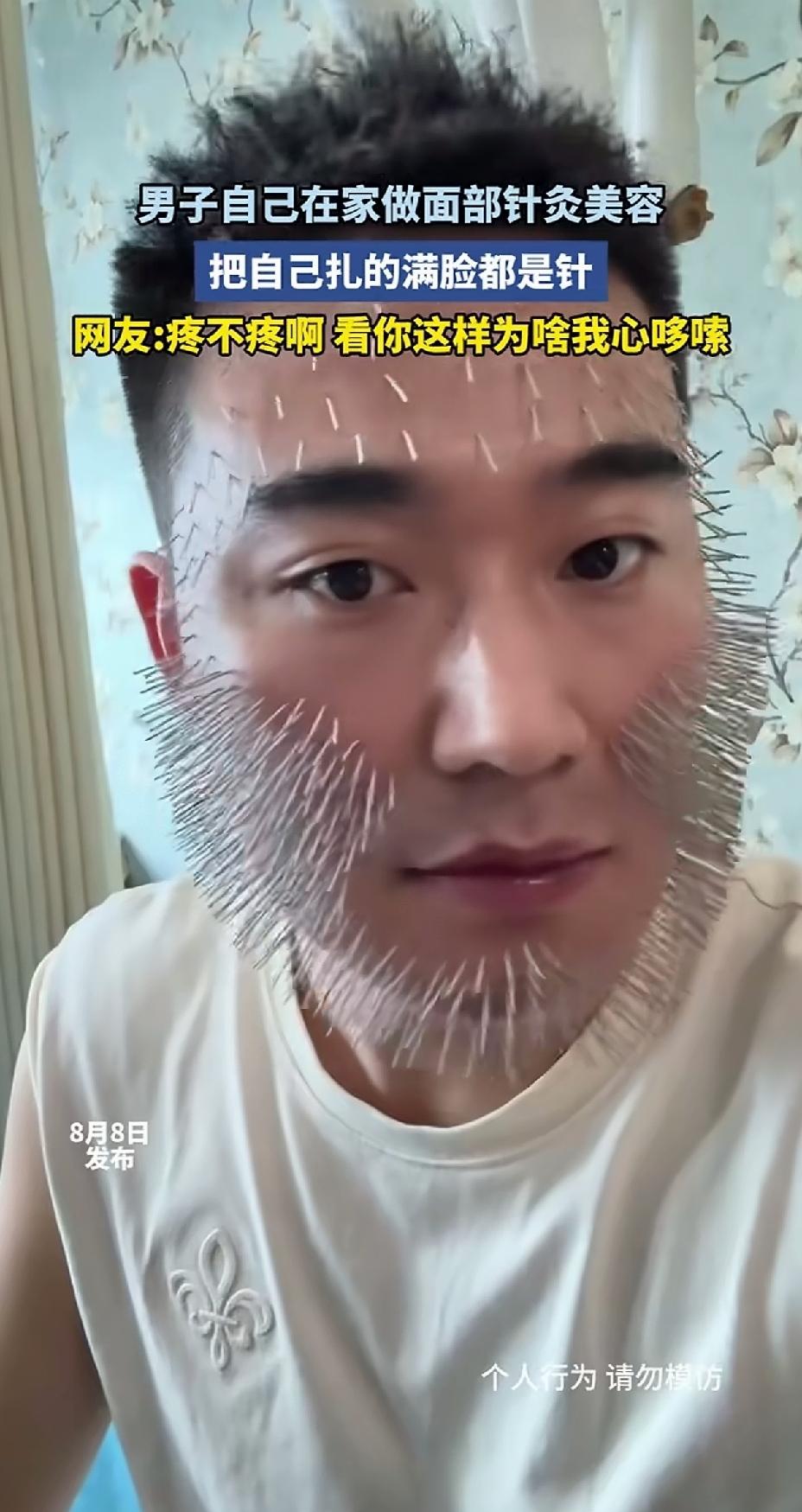 男子为了变得更年轻帅气，特意学了针灸美容，把自己脸上扎着密密麻麻的针，看着都痛，
