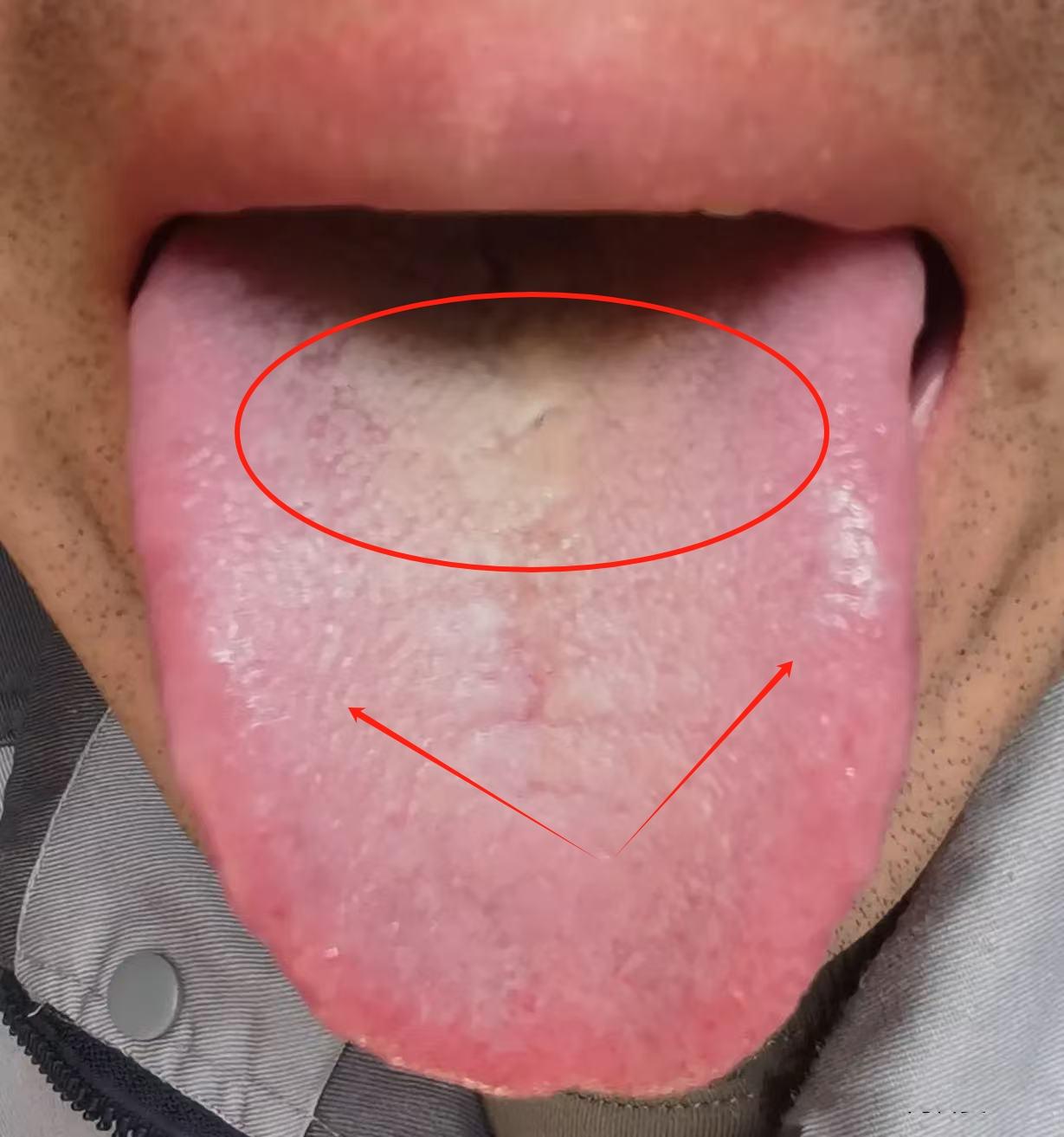 先清后补！中医破解“越补越虚”困局：湿热不除，吃仙丹也白费！

我们来看这位粉丝