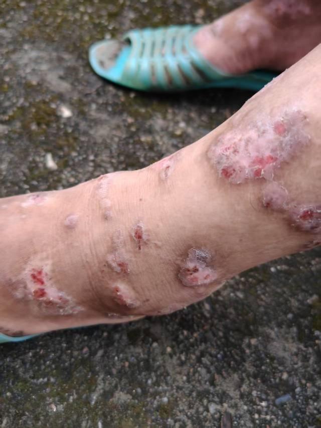 脚烂了又痛又痒是什么病？这不是我的脚啊，是村里人一个女的，看到她的第一眼我都吓一