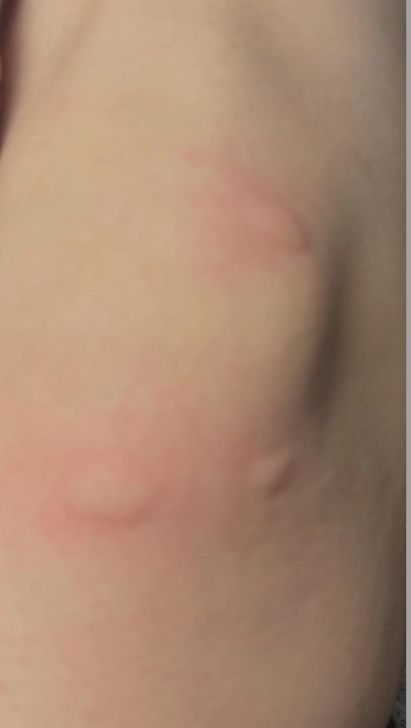 介似嘛！天津的冬天简直彻底“乱套”了！腿上被叮的蚊子包密密麻麻的，比耳朵眼炸糕还