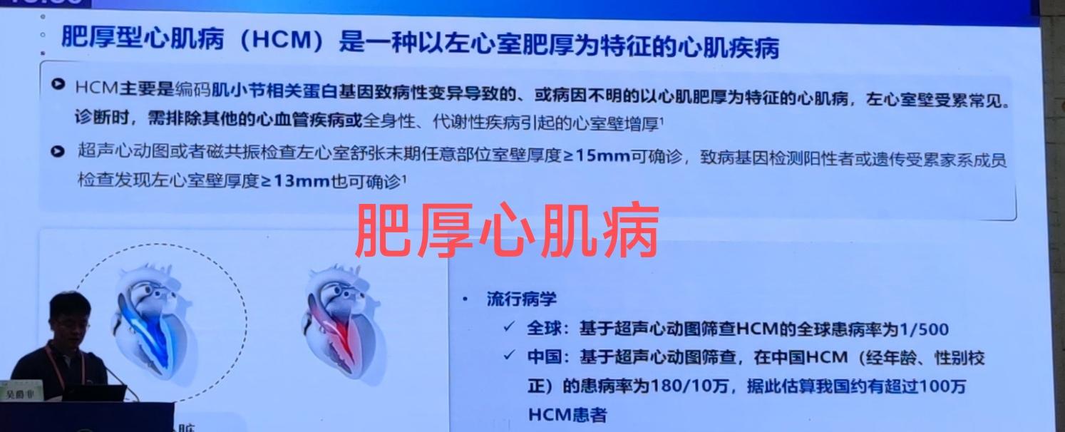 肥厚性心肌病超声
