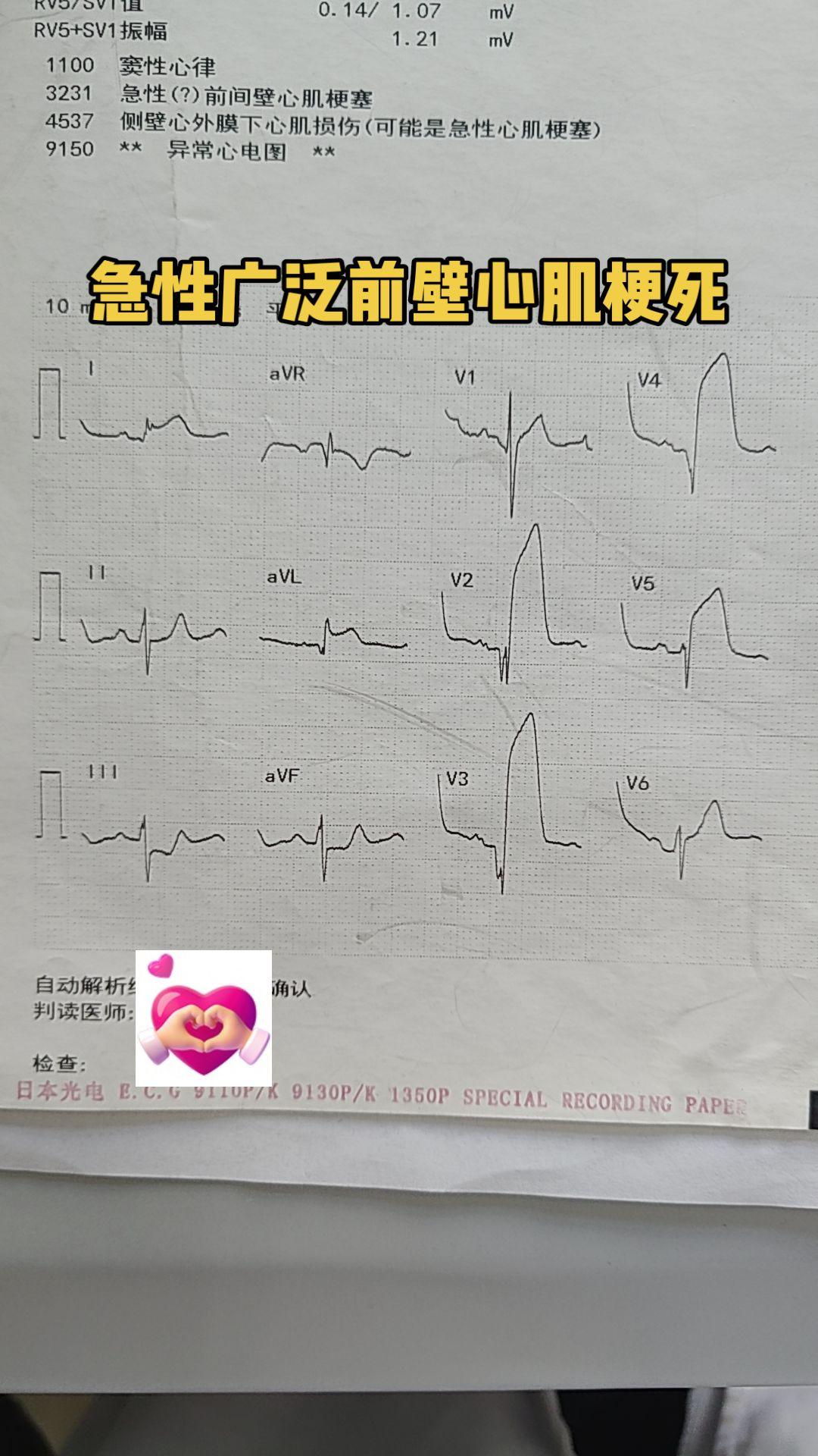急性广泛前壁心肌梗死。 医学生所谓“红旗飘飘”