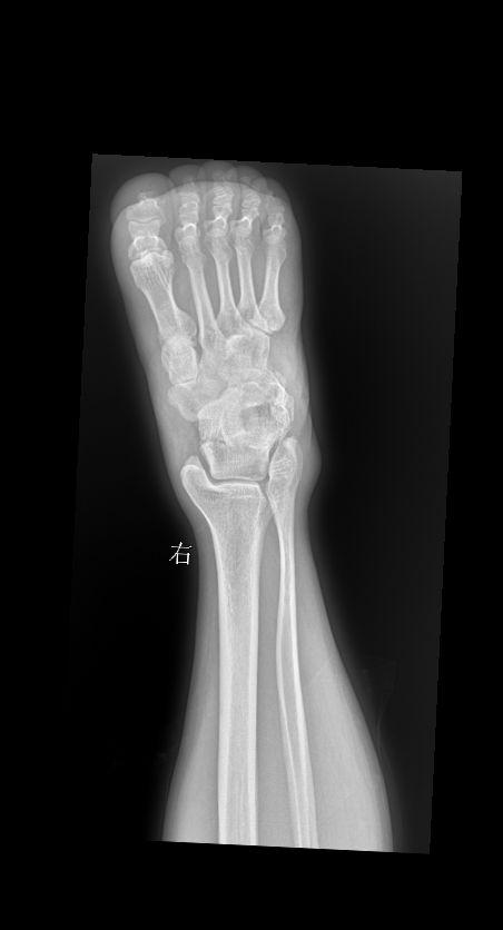 从梯子上落下 外伤就诊